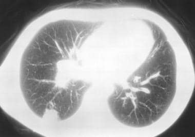Pulmonary nodule from infection with Coccidioides 