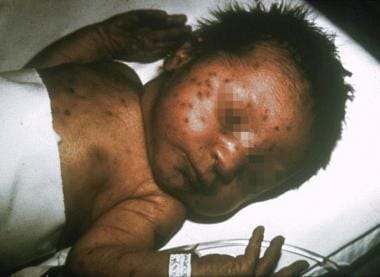 Viral infections and pregnancy. Infant with congen
