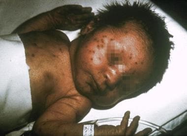 toxoplasmosis birth defects