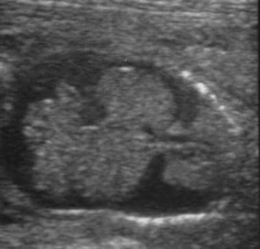 Hydropic fetus. Ultrasound image of coronal view o