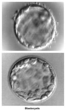 Infertility. Blastocysts. Image courtesy of Jairo 