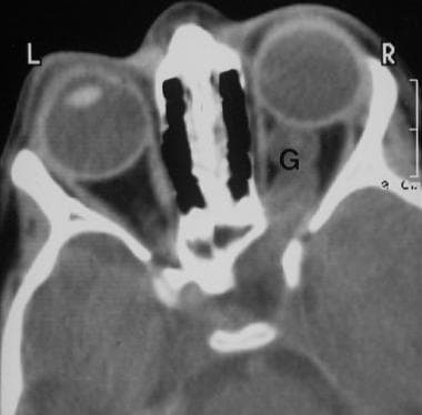 CT scan through the orbits in a patient with NF1 s