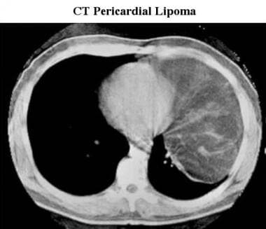 CT scan of a pericardial lipoma. A large, low-atte