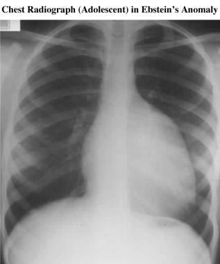 The chest radiograph shows classic radiographic fe