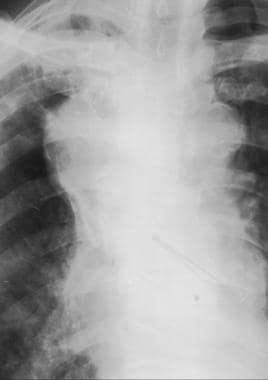 Frontal chest radiograph reveals calcification inv