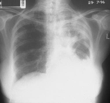 Chest radiograph in a 56-year-old woman with syste