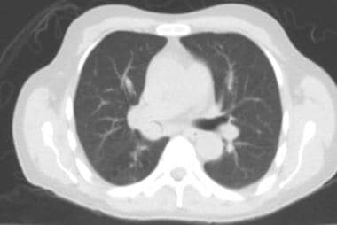Axial CT scan of the same patient at a higher leve