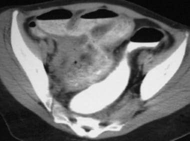 Crohn disease. Enteroenteric fistula. CT scan demo
