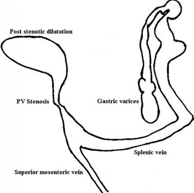Line diagram of findings on portal venous phase an