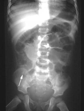 Plain abdominal radiograph in a 6-year-old boy who