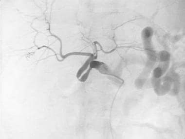 A-4: Digital subtraction angiogram depicts redunda