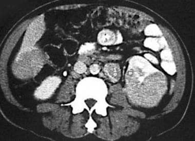 Computed tomography scan in a 53-year-old woman wi