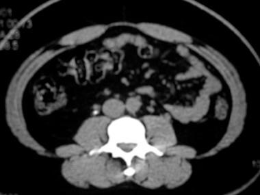 Right ureteral calculus with periureteral strandin