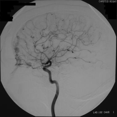 Selective right carotid angiogram in a patient wit