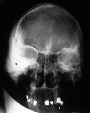 Anteroposterior projection skull radiograph showin
