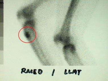 Delayed bone scan image of a 36-year-old man revea