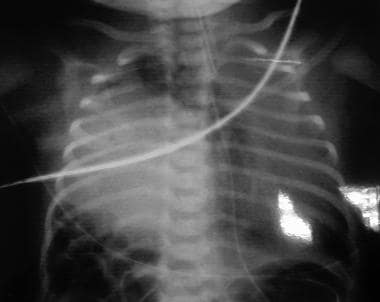 Anteroposterior (AP) chest radiograph of a right-s