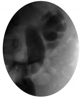 Voiding cystourethrogram (VCUG) of the left kidney