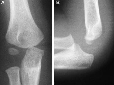 Subtle olecranon fracture. Anteroposterior (A) and