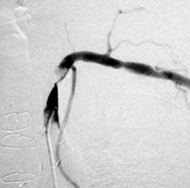 Selective arteriogram (same patient as shown in pr