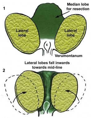 Resection of an enlarged median lobe allows the la