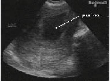 Pseudogestational sac of ectopic pregnancy can be 