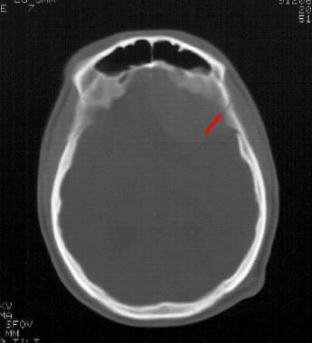 Linear skull fracture - Emergency neuroradiology. 