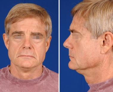 A 58-year-old man with premature aging, demonstrat