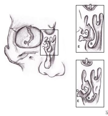 (A) Frontal sinus, (B) middle turbinate, (C) ethmo