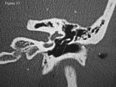CT scan, temporal bone. The facial nerve (a) cours