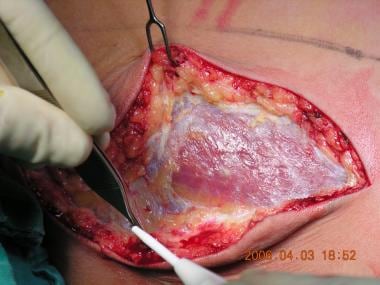 Subcutaneous dissection to the muscular fascia. 