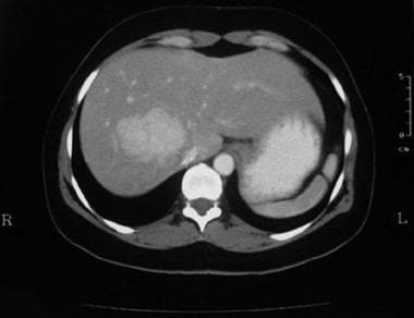 Enhanced axial CT scan through the liver in the ar