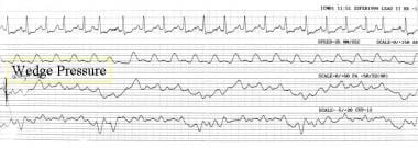 Simultaneous recording of ECG helps identify V wav