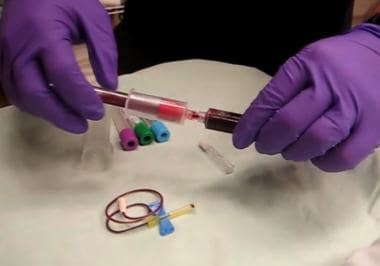 Phlebotomy. Transfer of blood from syringe to vacu