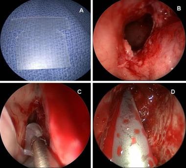 Endoscopic placement of right frontal sinus stent 