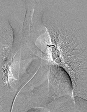 Digital subtraction angiography image shows the pi