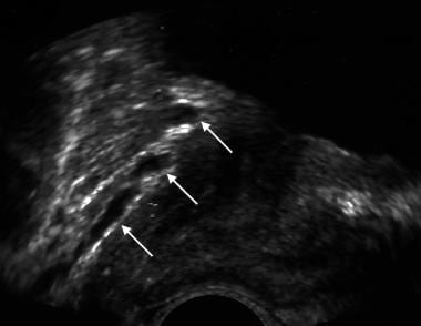 Sagittal image of a prostate. White arrows show da