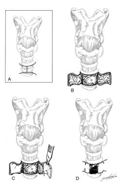 Pediatric Tracheostomy: Overview, Periprocedural Care, Technique