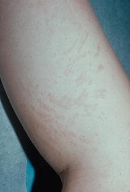Systemic juvenile idiopathic arthritis (JIA) rash.