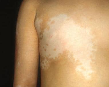 Segmental vitiligo. 