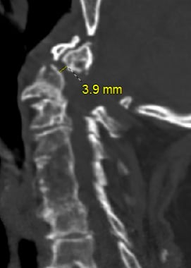 jefferson fracture transverse ligament