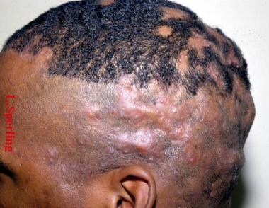 Side view of a black man with painful cutaneous no