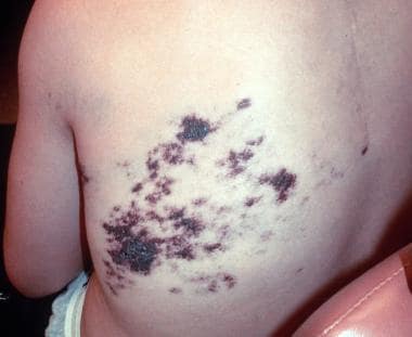 Cutaneous vascular lesions. Courtesy of L. Cooke, 