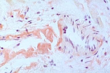 nodular amyloidosis