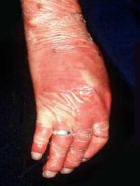 Nail dystrophy and inflammation of the nail folds.