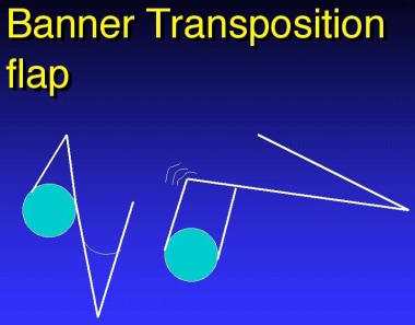 Banner transposition flap. 