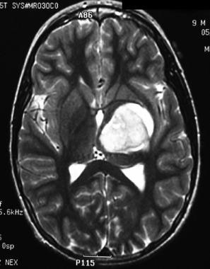 A 9-year-old boy presented with headaches and grad
