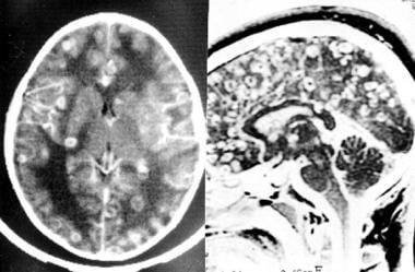 Neuroimaging in neurocysticercosis. Cysticercotic 