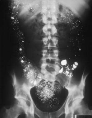 This is a 1-view, abdominal, upright radiograph in