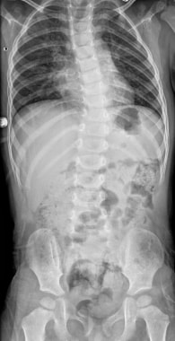 Infantile idiopathic scoliosis after several month